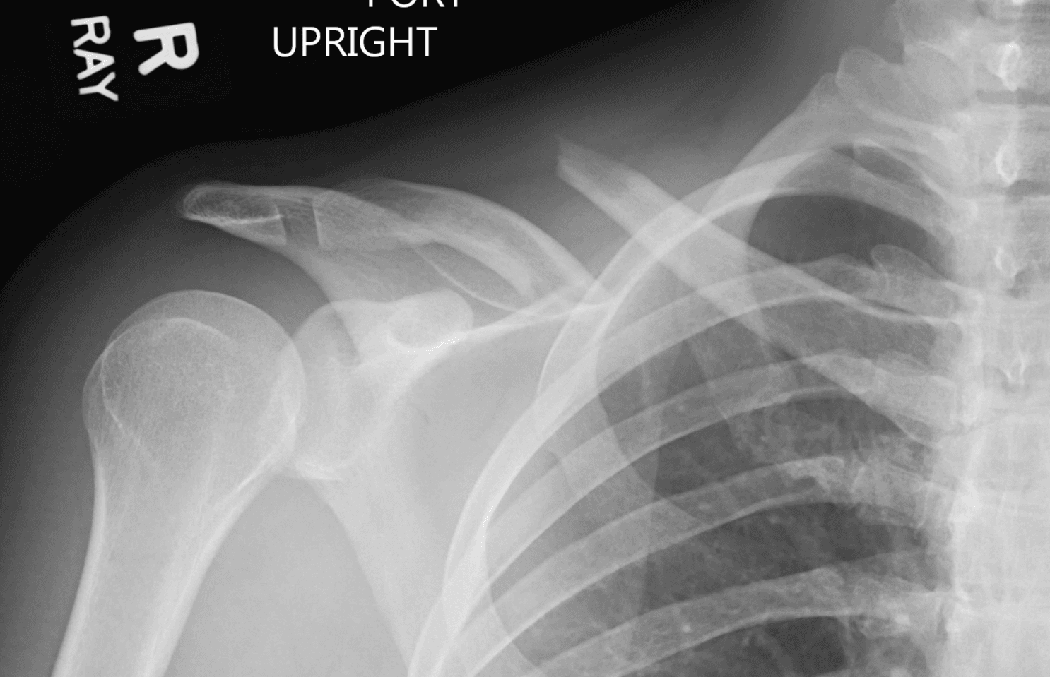 X-ray showing a displaced midshaft clavicle fracture