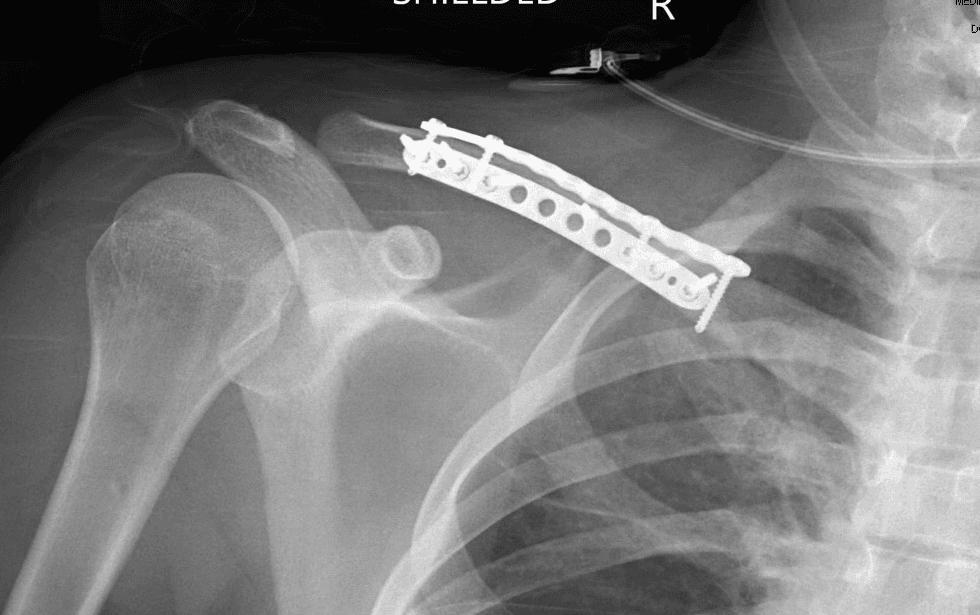 Post-operative X-ray showing a healed clavicle fracture with plate and screws